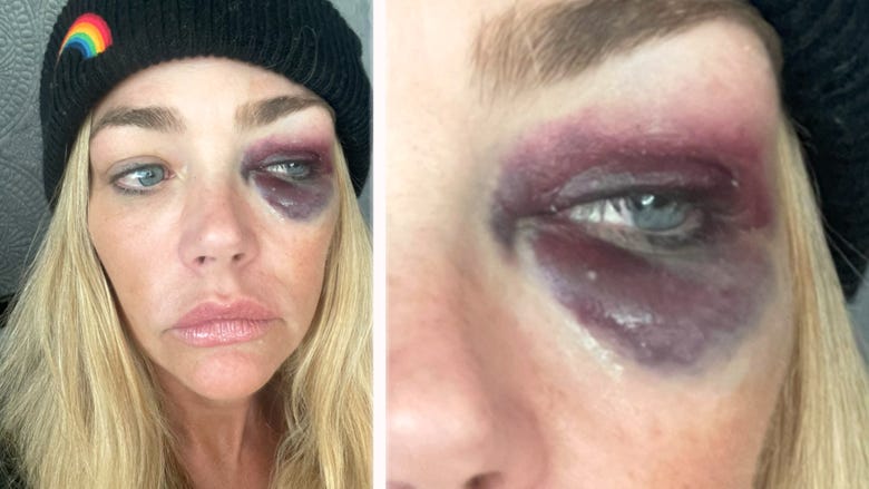 Denise Richards Divorce Docs Reveal Domestic Abuse Claims: Shocking Images of Black Eye